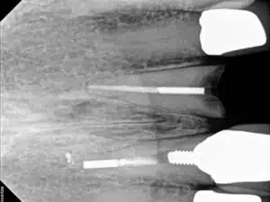 Dental Implant surgical photos