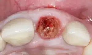 Dental Implant surgical photos