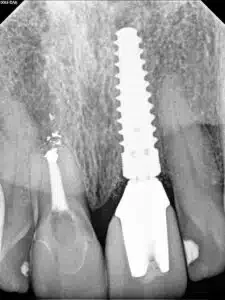 Dental Implant surgical