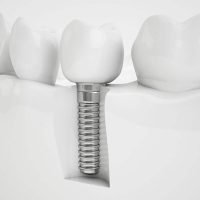 Same Day Dental Implants